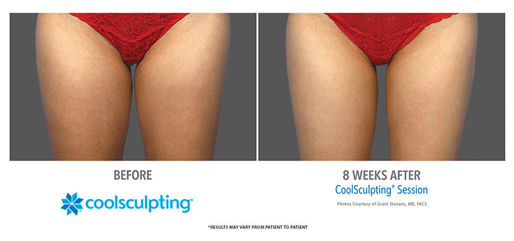 coolsculpting-inner-thighs-yucaipa-dr-jones