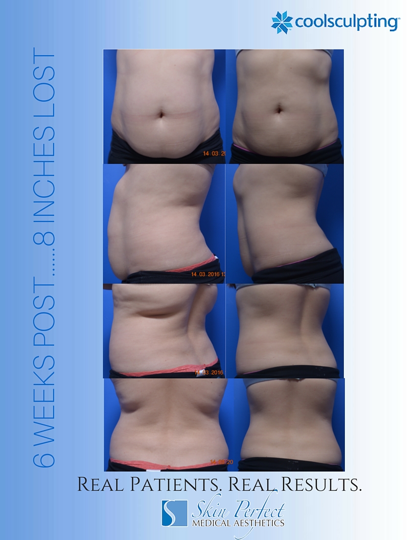 CoolSculpting - Rancho Cucamonga, CA