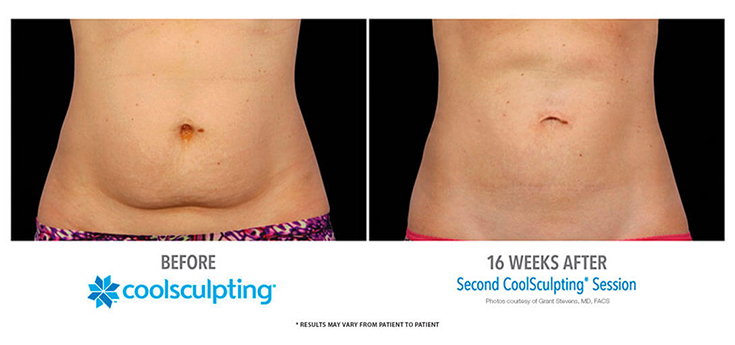 CoolSculpting - Abdomen - Rancho Cucamonga, CA