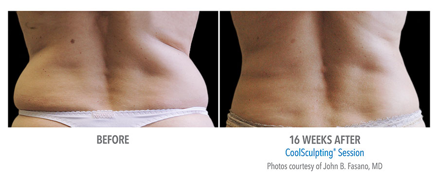 coolsculpting-love-handles